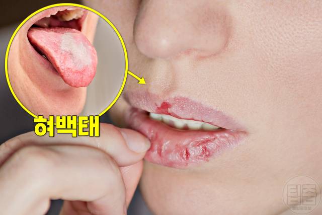 혀백태 원인 제거 혀 백태 안없어짐 입마름 건조증