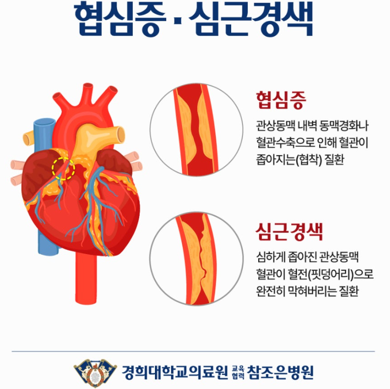 협심증과 심근경색, 무엇이 다른가요?