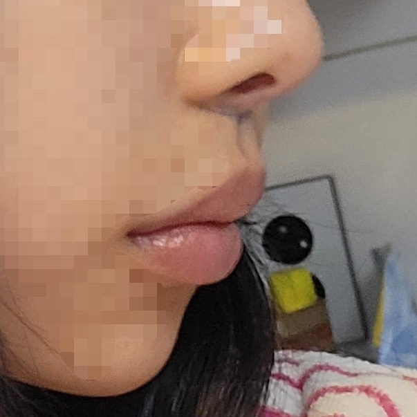 인중 축소 수술 후기