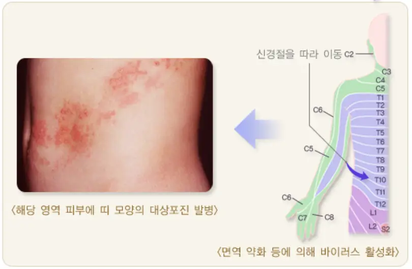 대상포진-증상이-발병하는-과정을-설명한-질병관리청의-자료
