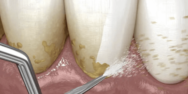 치석제거 스케일링부터 보험은 안되는 파우더스케일링 비교정리