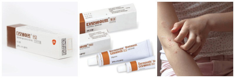 더모베이트 연고, 습진 사진