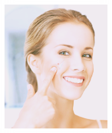 쥐젖 생기는 이유, 제거 방법 3분 총정리