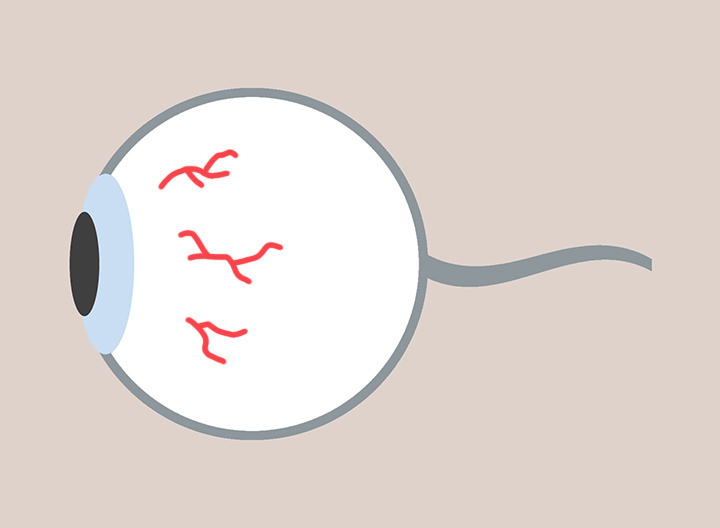 유리체-출혈-모습