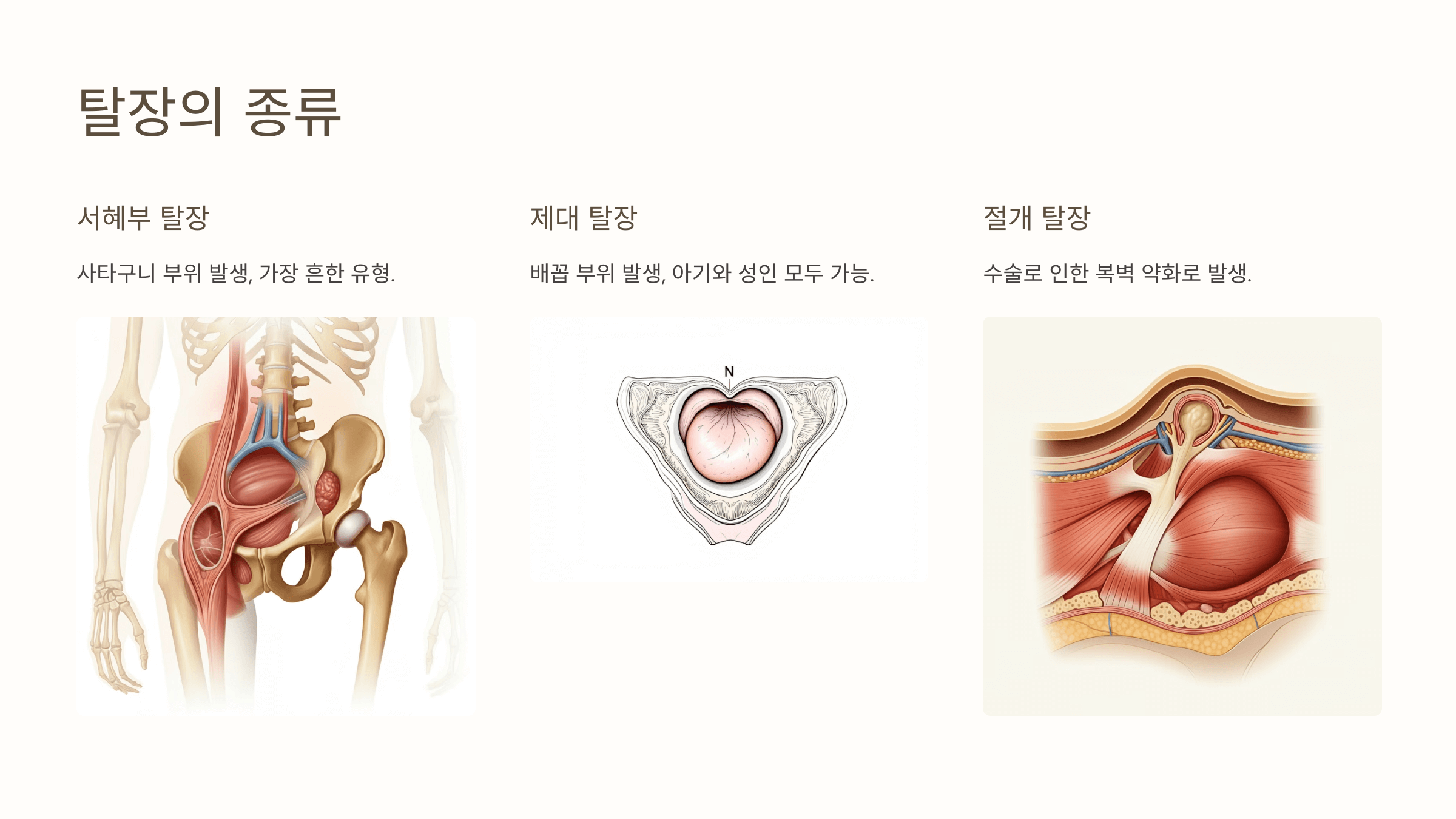 탈장과 관련된 사진입니다.