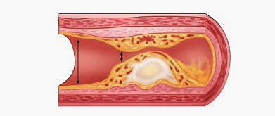 콜레스테롤 낮추는 음식1