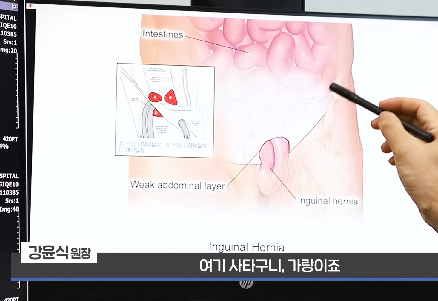 사타구니-탈장