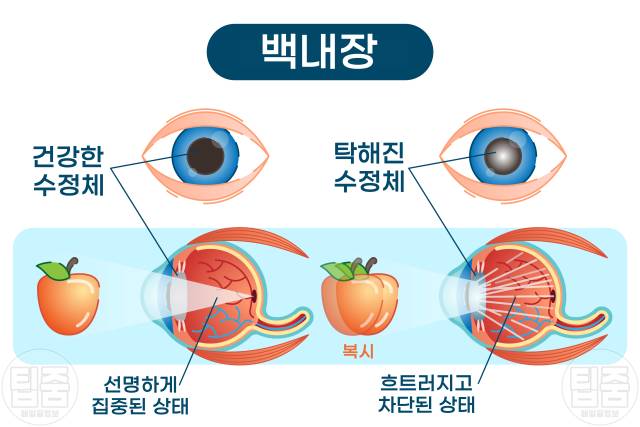 백내장 초기증상 눈이 뿌옇게 보여요 백내장 자가진단 복시
