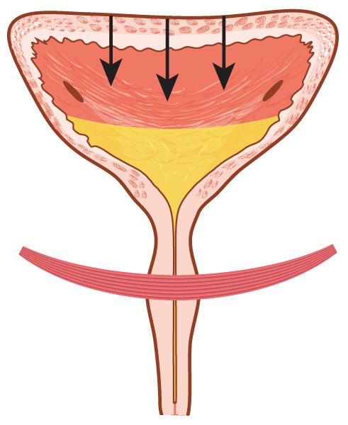 요실금 치료방법