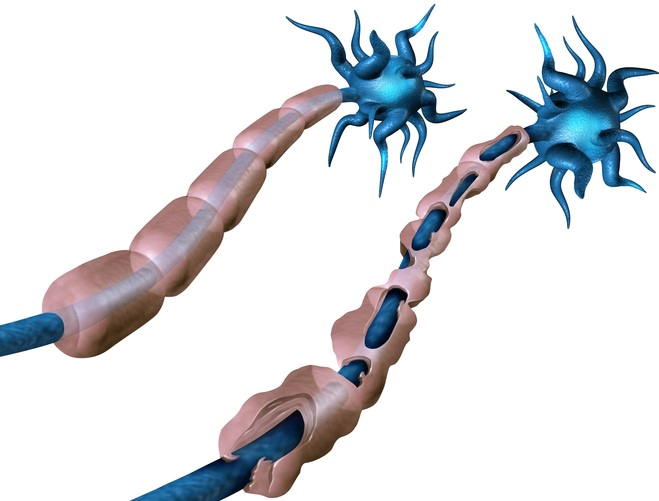 다발성 경화증 원인