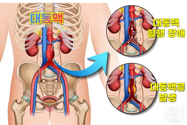 배에서 심장박동 복부대동맥류 증상 복부대동맥류 자가진단