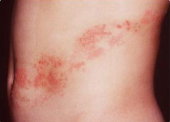 대상포진예방접종&amp;#44; 백신종류 비용