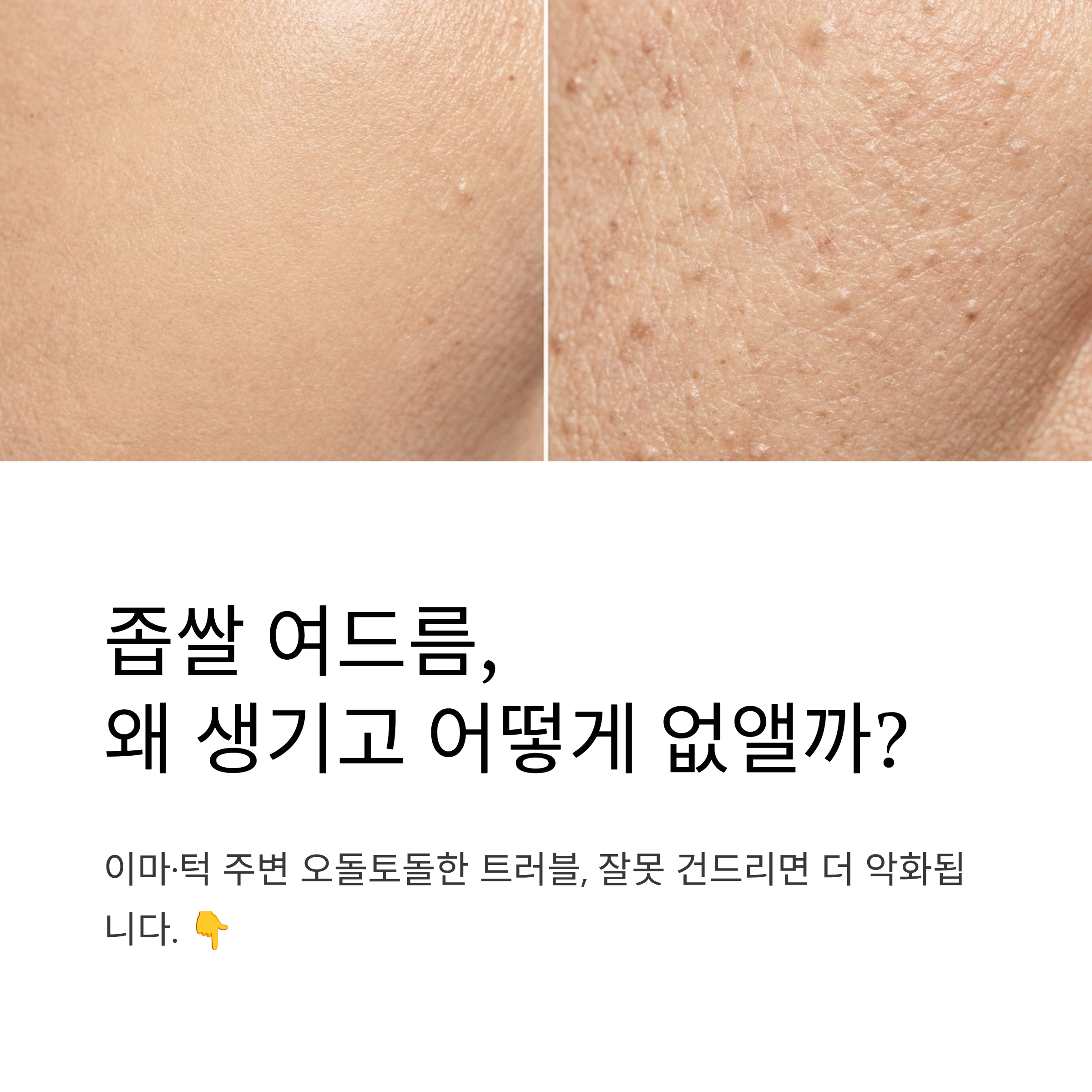 좁쌀 여드름