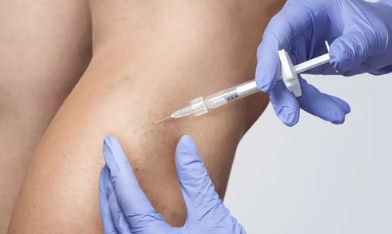 하지정맥류 수술