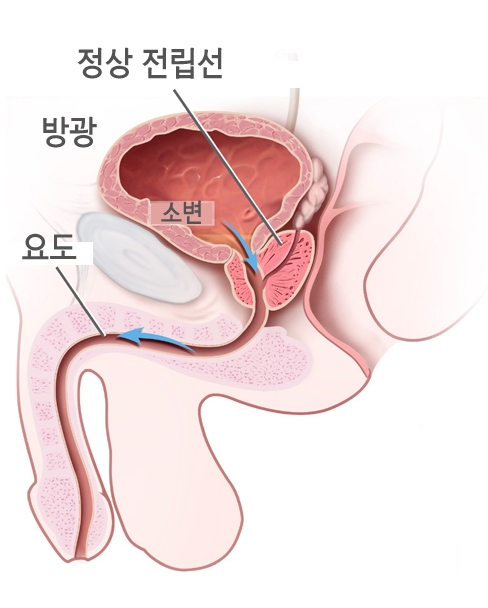 정상 전립선