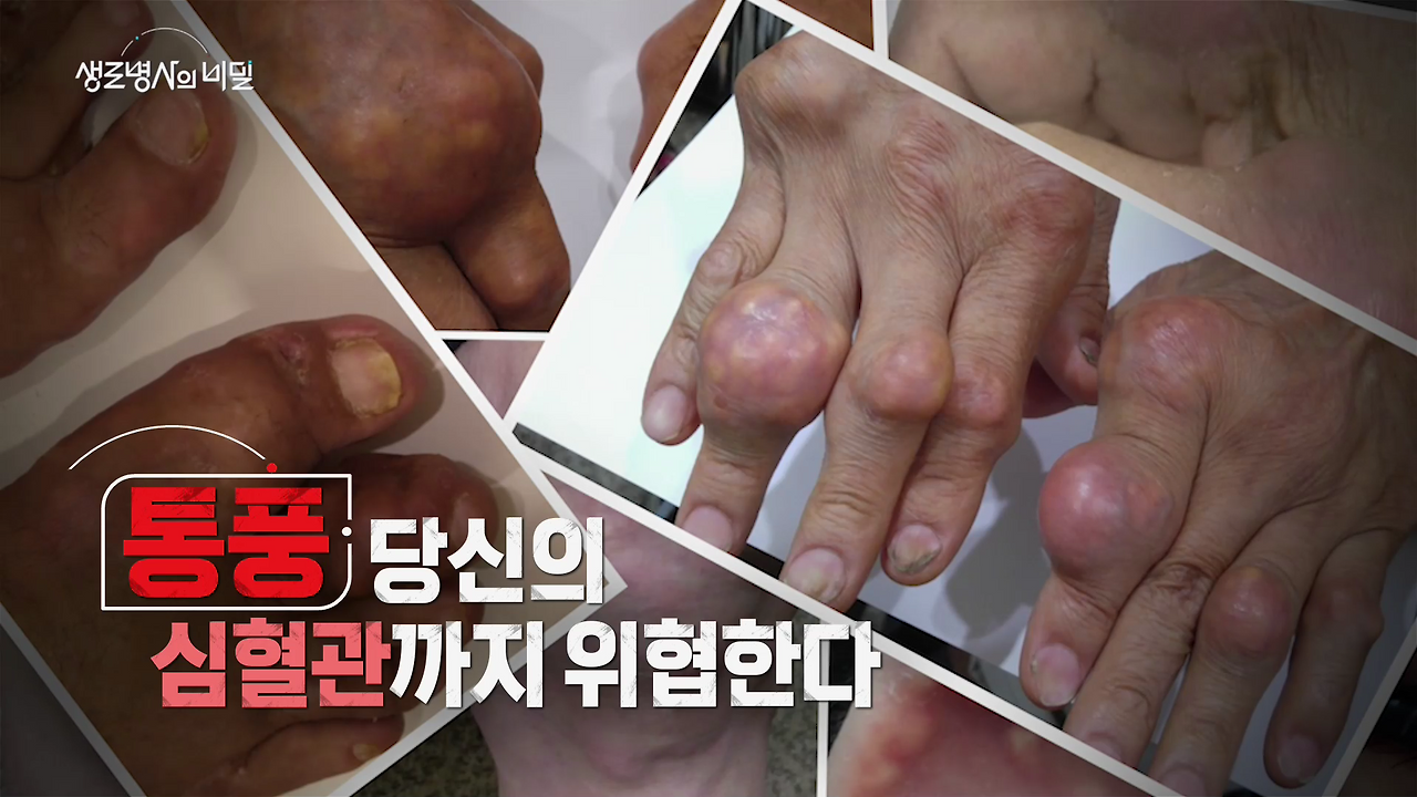 생로병사의 비밀 통풍