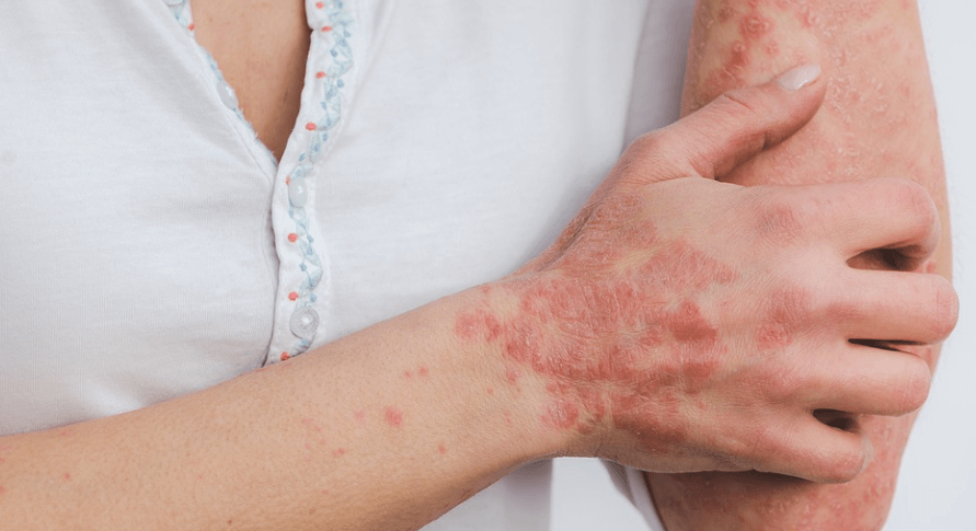 피부 질환으로 팔을 긁고 있는 남성