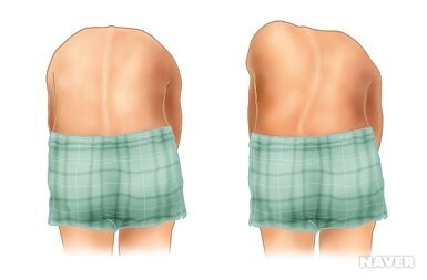 척추측만증 검사