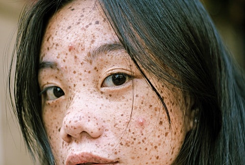 여드름 피부과 추천하는 곳&#44; 쉽게 찾는 방법은?