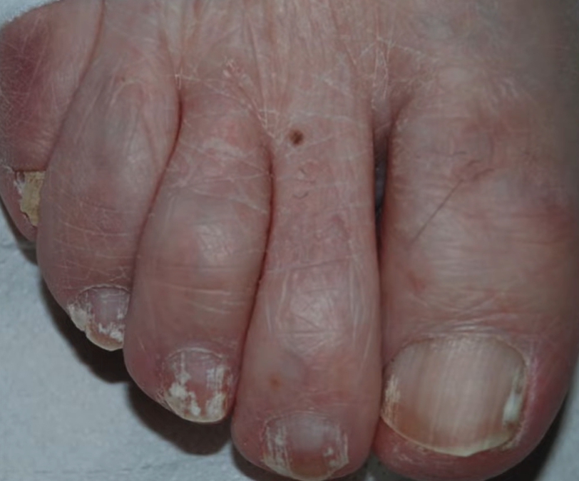 손톱이 잘 부러지는 이유