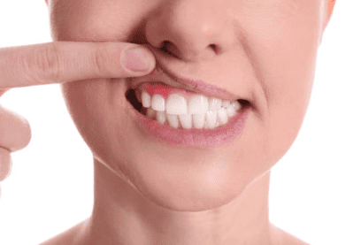 잇몸 염증 치료약