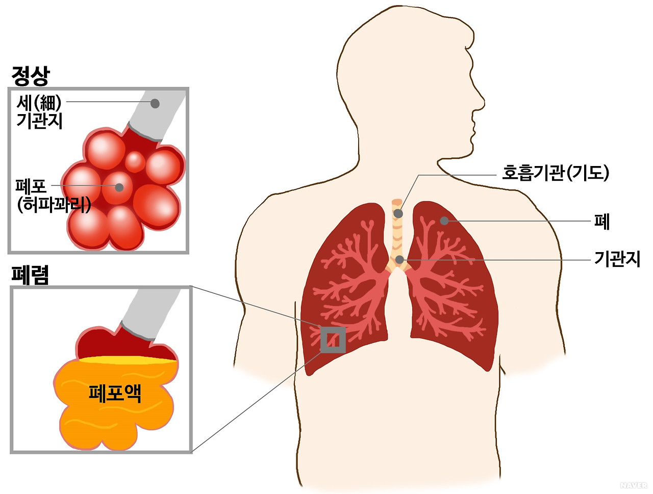 폐렴 증상&middot;원인&middot;치료 총정리