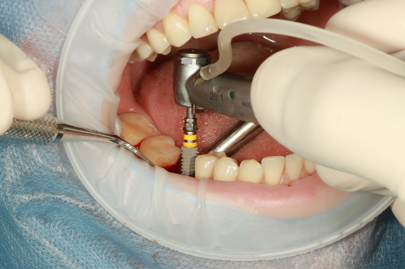 부산임플란트가격