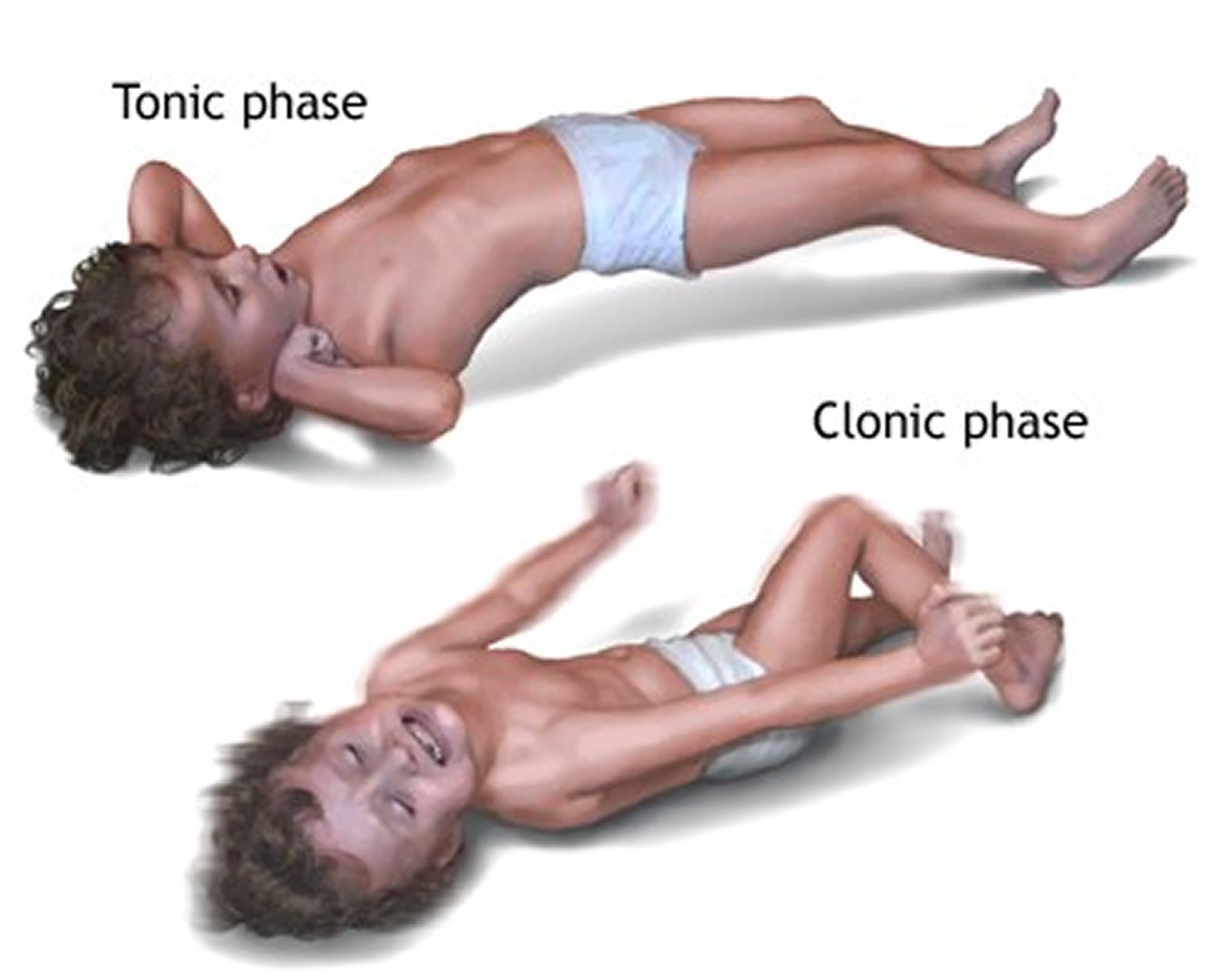 Generalized tonic clonic seizure