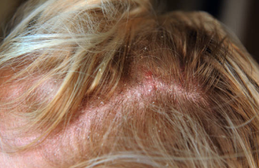 두피 염증