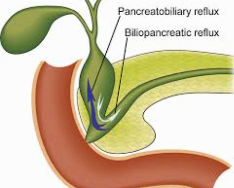 Anomalous PancreaticoBiliary ductal Union &amp;#44; APBU