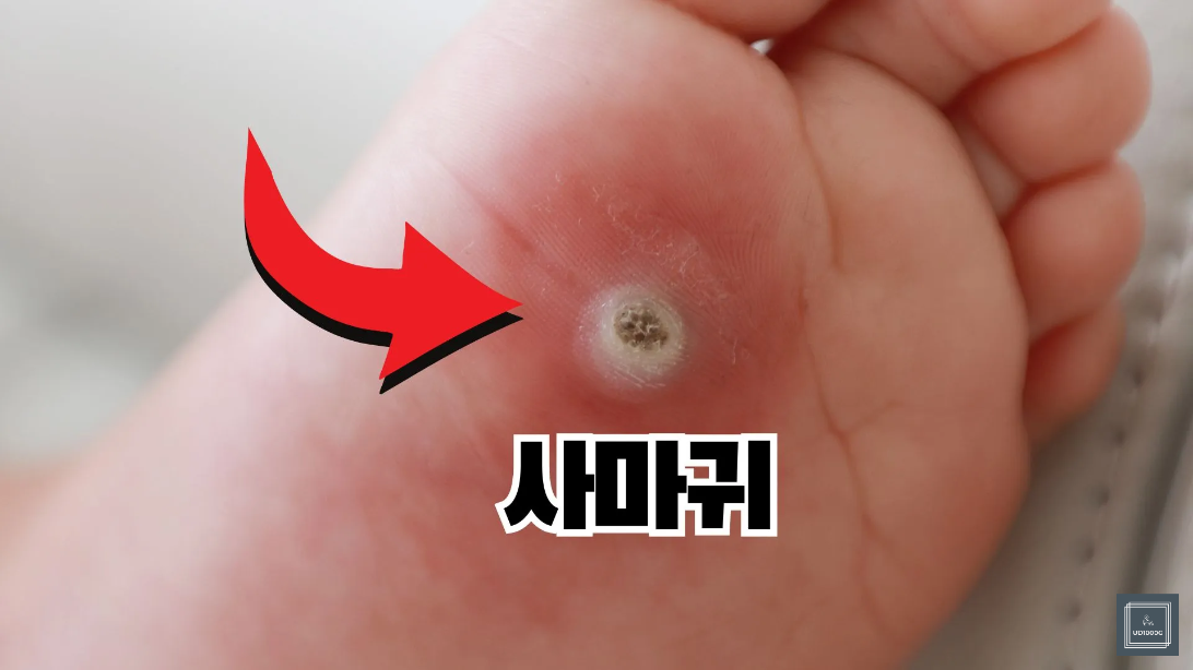 티눈-사마귀-굳은살