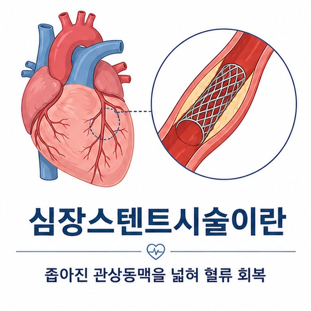 좁아진 관상동맥 안에 스텐트가 펼쳐져 혈관을 지지하는 모습을 통해 심장 스텐트 시술이 혈류를 회복하기 위한 관상동맥중재술임을 보여 주는 그림