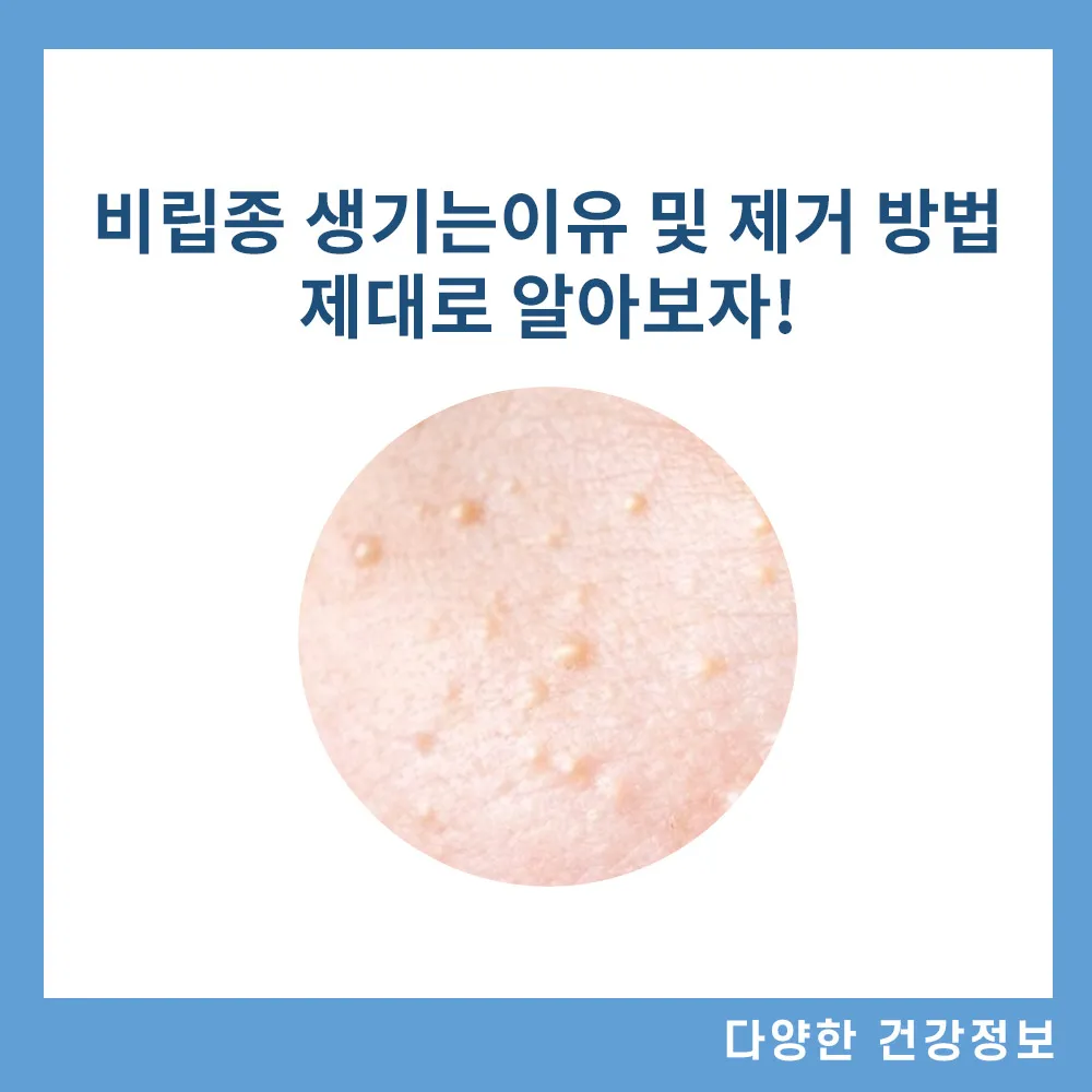비립종-생기는-이유-없애는-방법