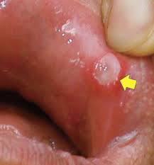 입안이 자주 허는 이유