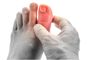 발가락이 붓고 가려워, 아파