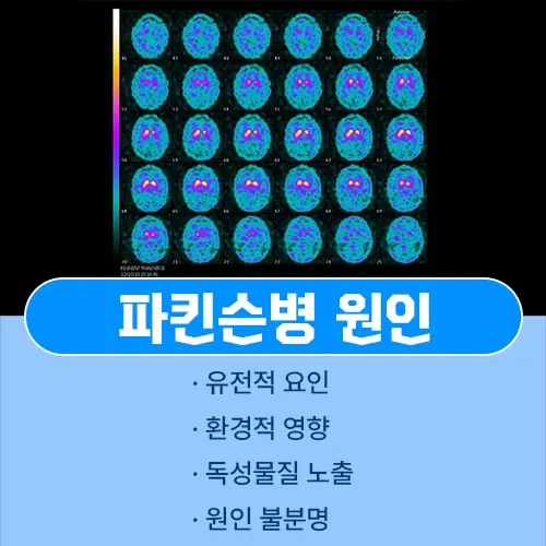 파킨슨병 원인