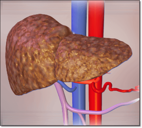 간 섬유화 증상 이미지