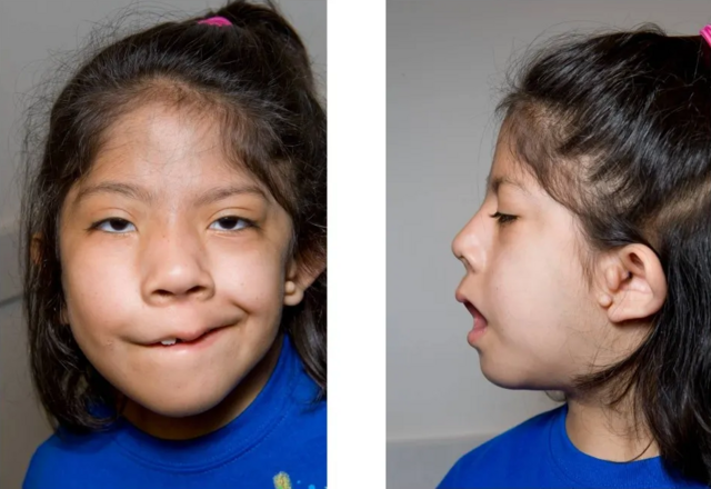 골덴하 증후군을 앓고 있는 여성의 얼굴