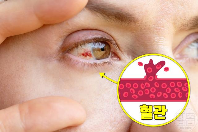 눈 실핏줄 터지는 이유 눈혈관 터짐 결막하출혈 원인 당뇨병 고혈압