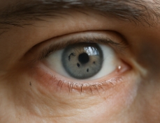 비문증 치료방법