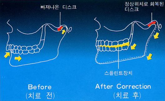 스플린트장치치료