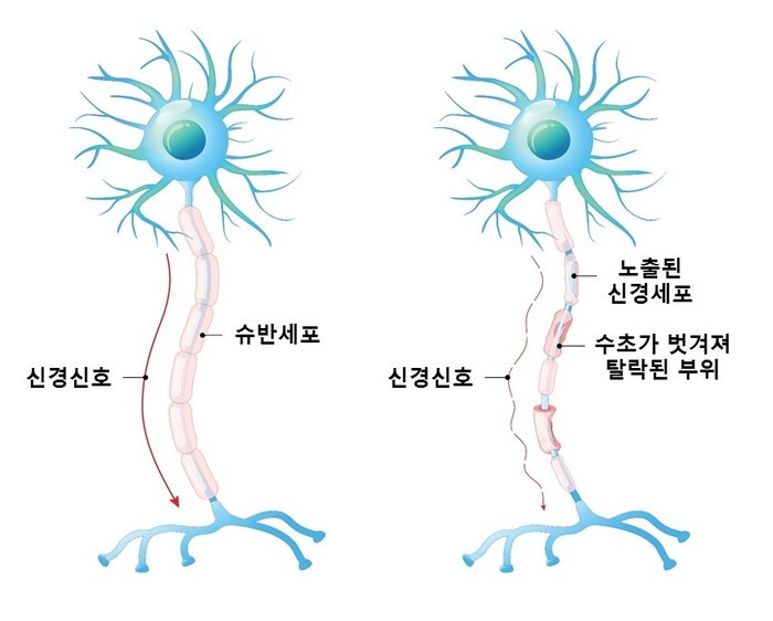 다발성경화증 원인부터 증상&middot;치료