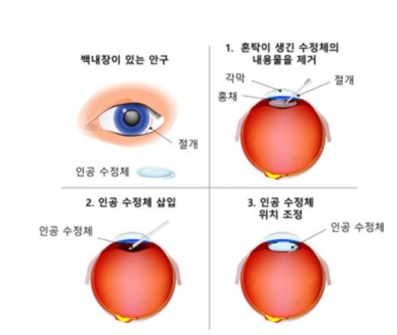 백내장
