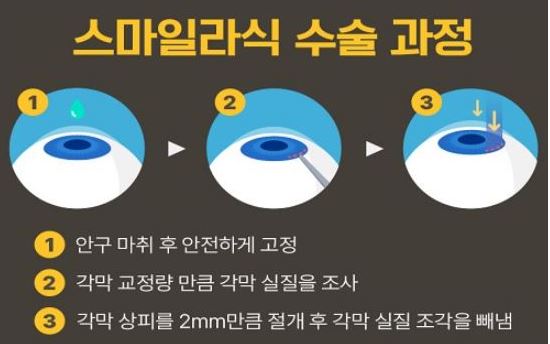 스마일라식 수술 과정