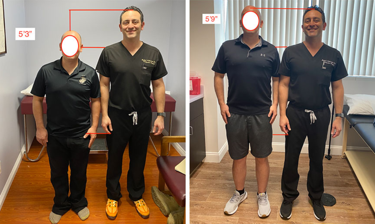 키 크는 수술의 장점과 단점