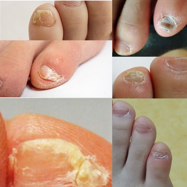 새끼발톱-무좀-증상-치료방법