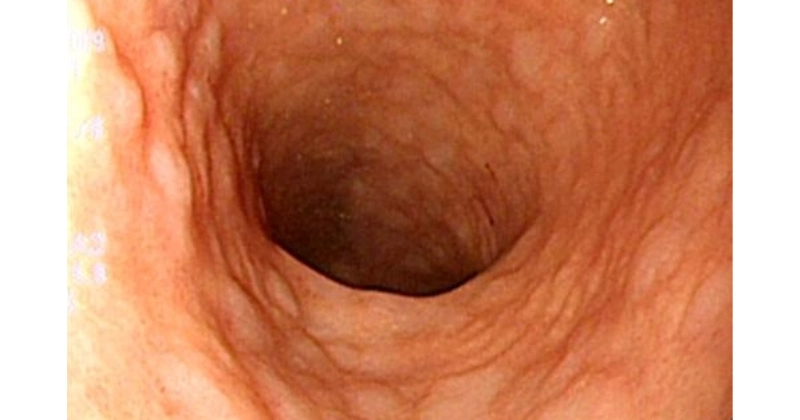 장상피화생 위내시경 모습