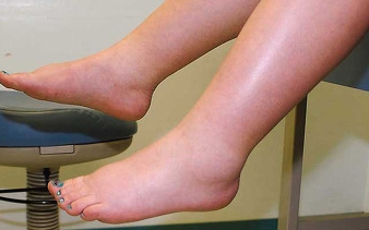 다리가 붓는 이유