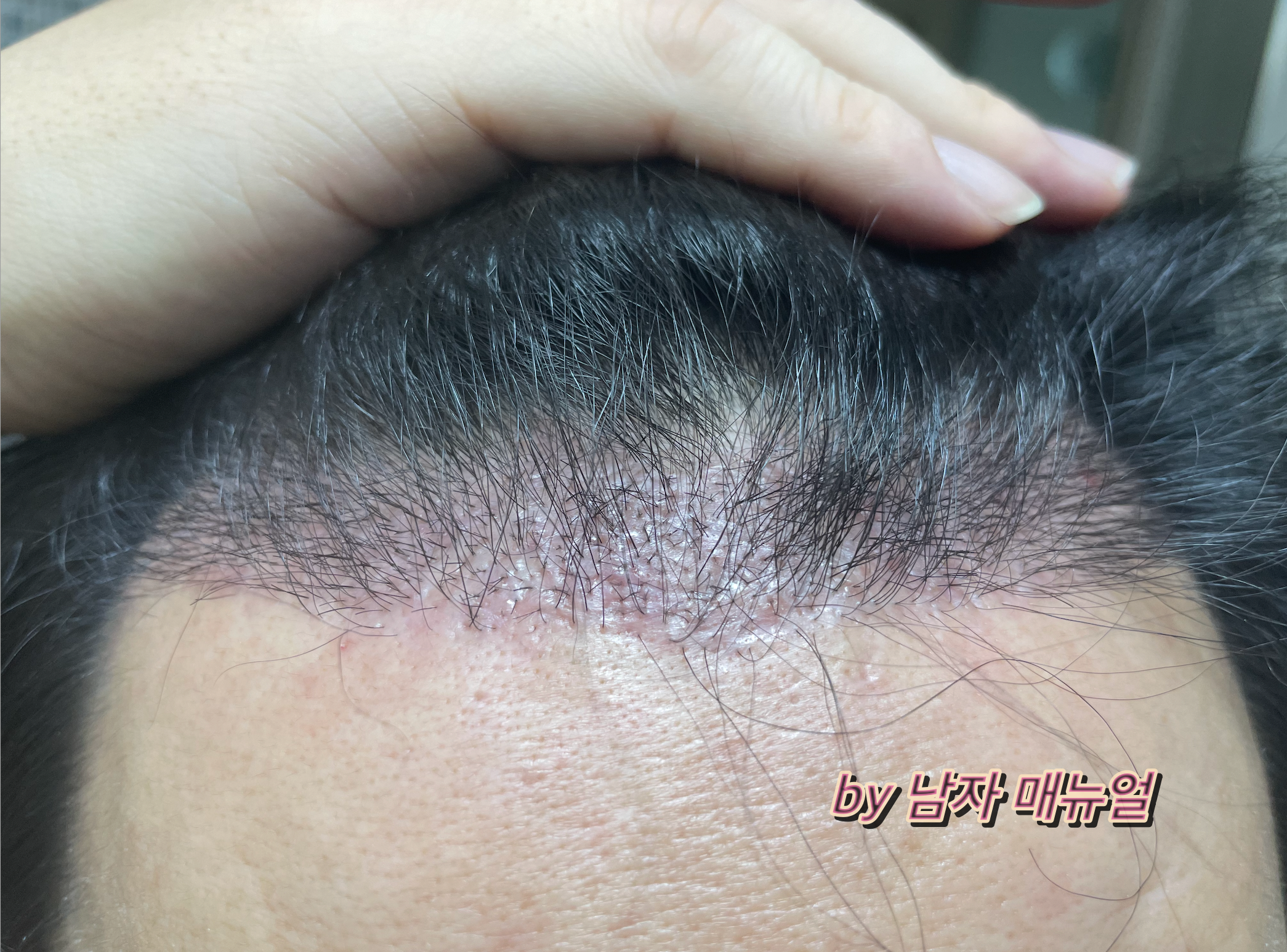 모발이식-암흑기