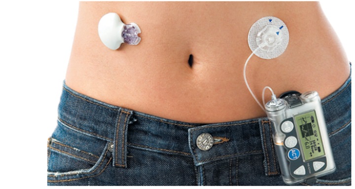 연속-혈당측정기